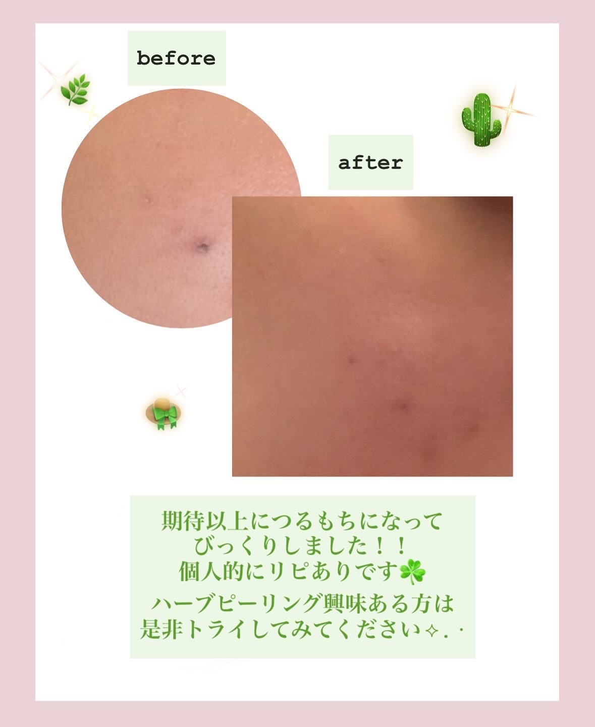 ハーブピーリング/on:myskin/ピーリングを使ったクチコミ(5枚目)