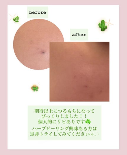 ハーブピーリング/on:myskin/ピーリングを使ったクチコミ(5枚目)