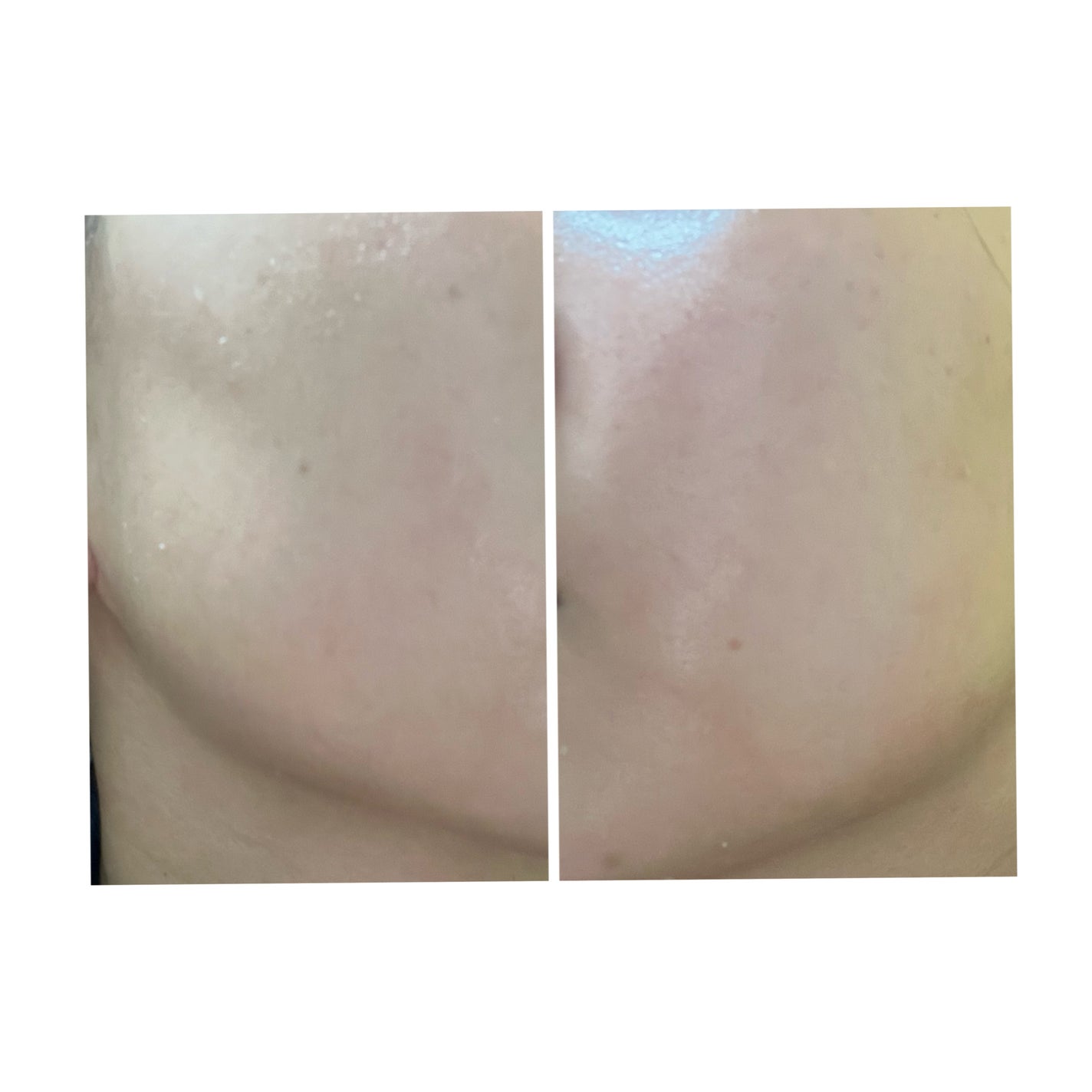 ぽむ on LIPS 「2023.9.13皮膚科に受診 エピデュオとヘパリン処方1枚目..」(1枚目)