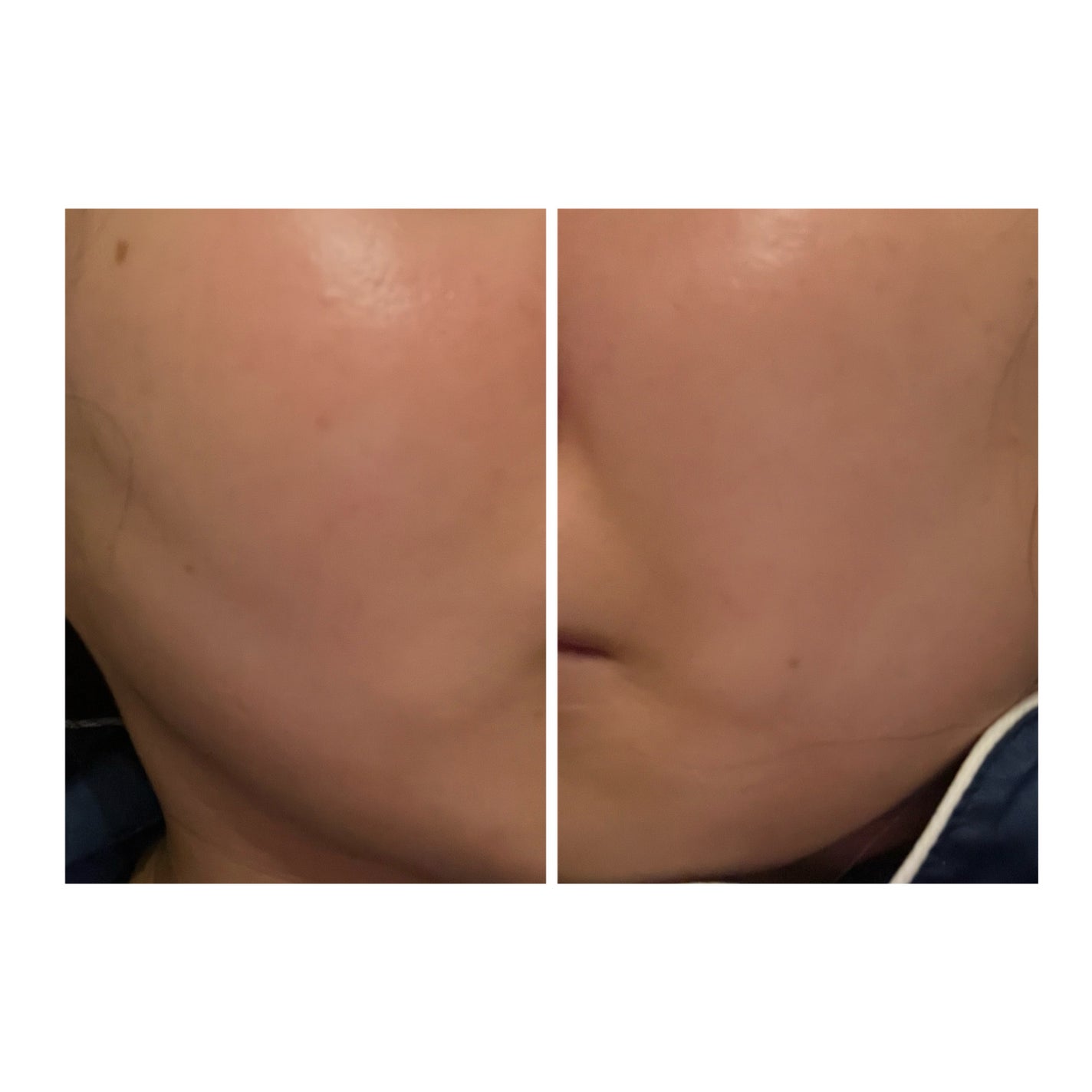 ぽむ on LIPS 「2023.9.13皮膚科に受診 エピデュオとヘパリン処方1枚目..」(2枚目)