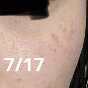 ハイドロキノンクリーム6%/KITEN/フェイスクリームを使ったクチコミ(3枚目)