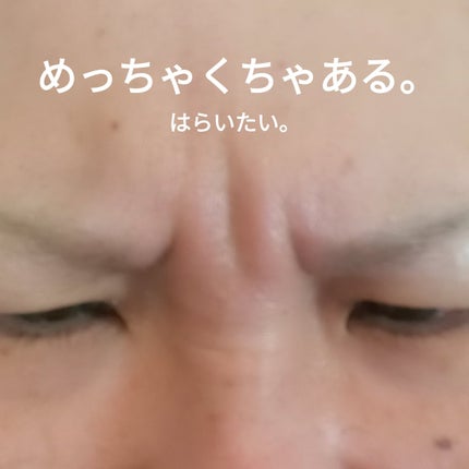韓国製ボツリヌストキシン/SBC/その他を使ったクチコミ(3枚目)