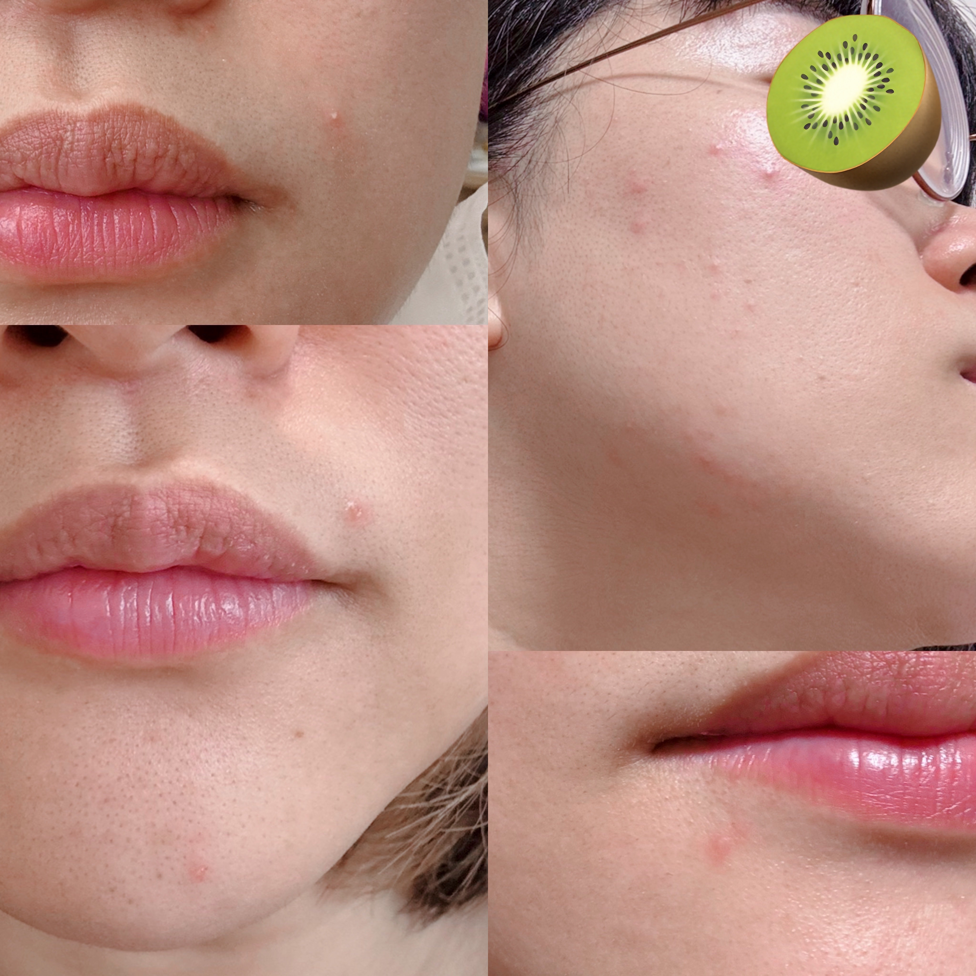 クリアフル モイスチャーL(さっぱりタイプ)/オルビス/乳液を使ったクチコミ（2枚目）