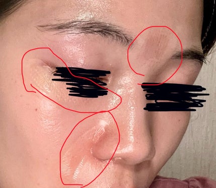 ビタアクティブマイクロクリスタルパッチ/ダーマファーム/シートマスク・パックを使ったクチコミ(5枚目)