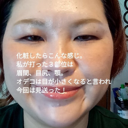 ビヨンセ奥二重向上委員長🥸LIPSパートナー🥳 on LIPS 「SBCで韓国製ボツリヌストキシンを41歳にして初めて打ってきた..」(5枚目)
