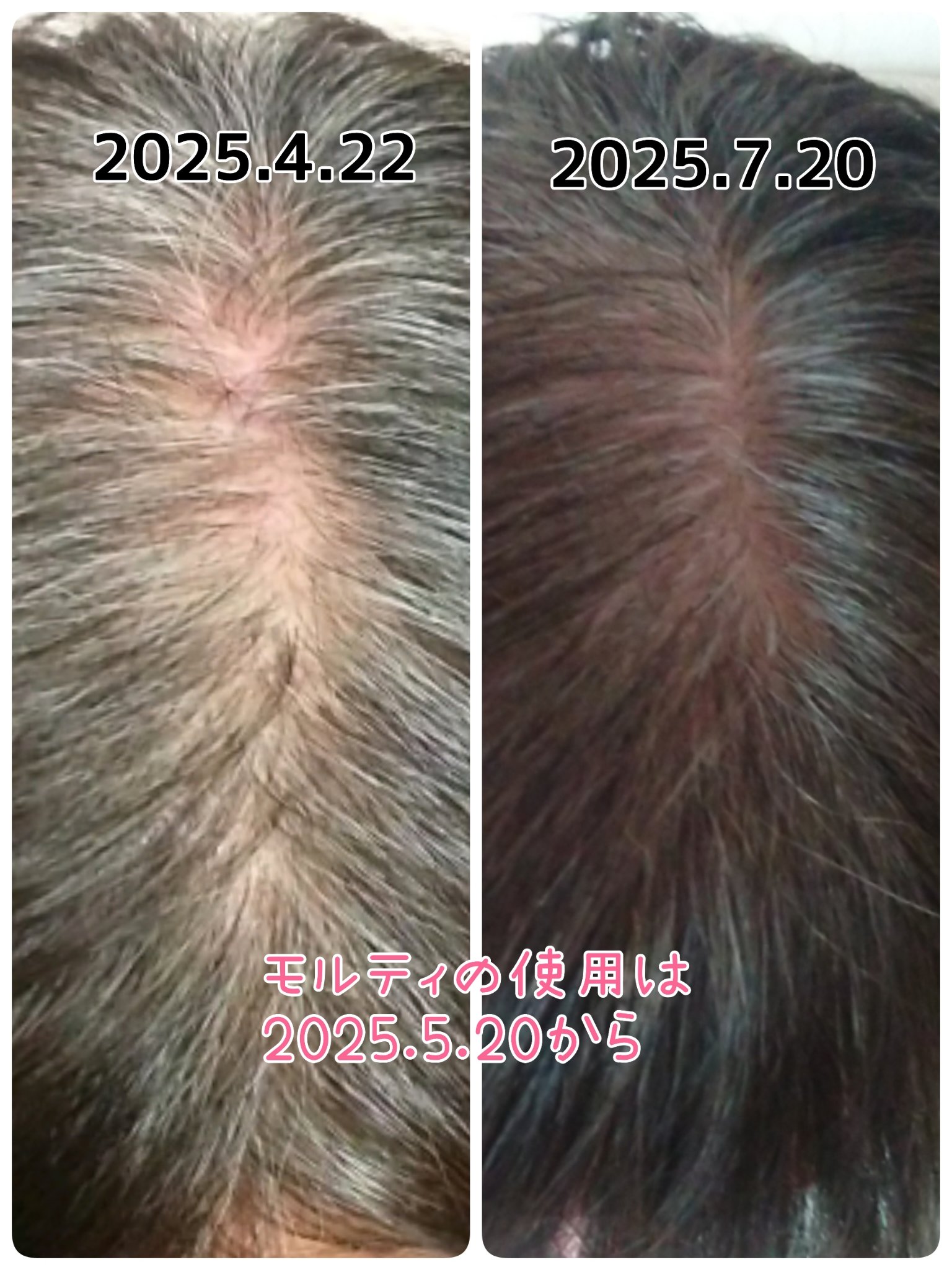 モルティ 薬用育毛エッセンス/モウガL/頭皮ローションを使ったクチコミ（3枚目）