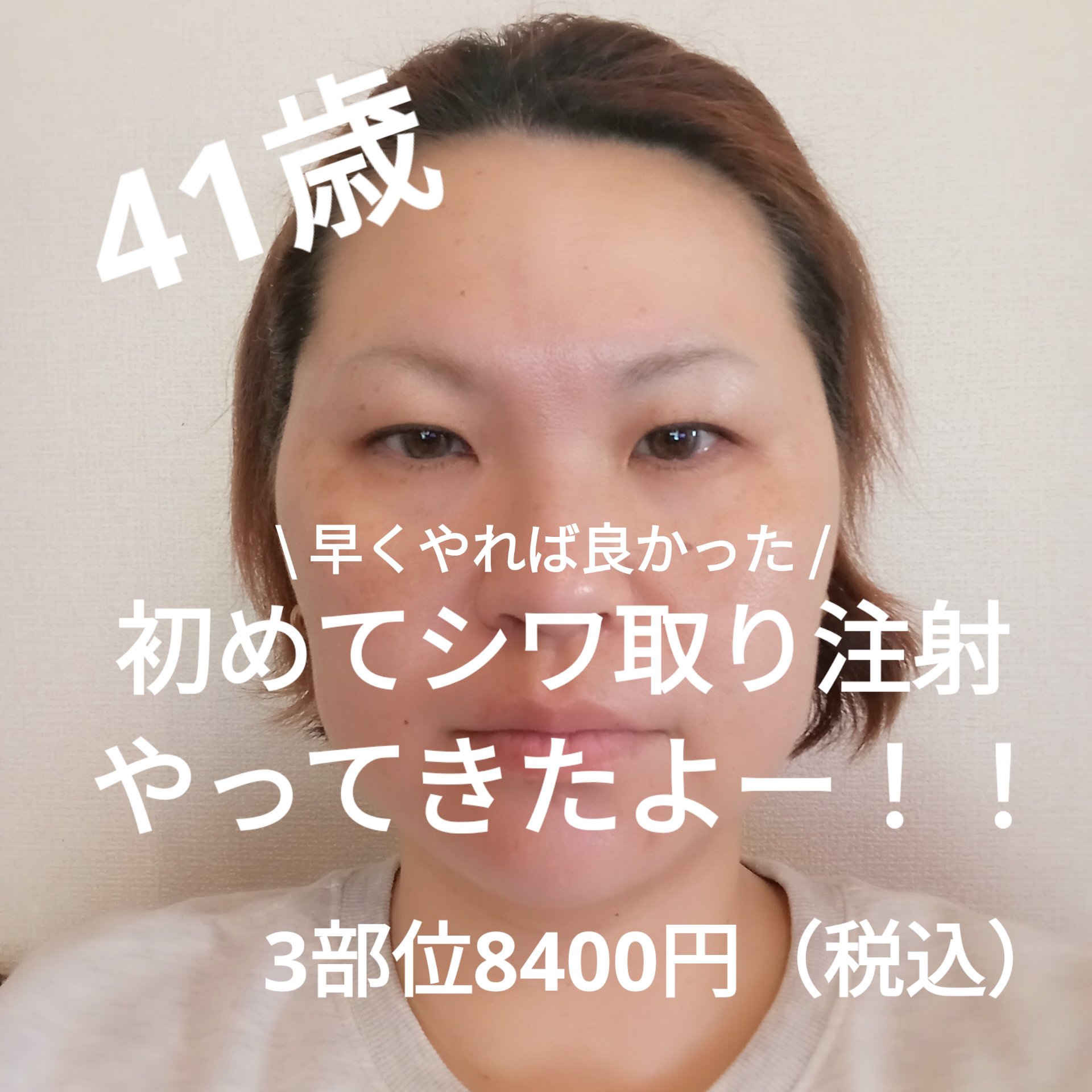 韓国製ボツリヌストキシン/SBC/その他を使ったクチコミ（1枚目）