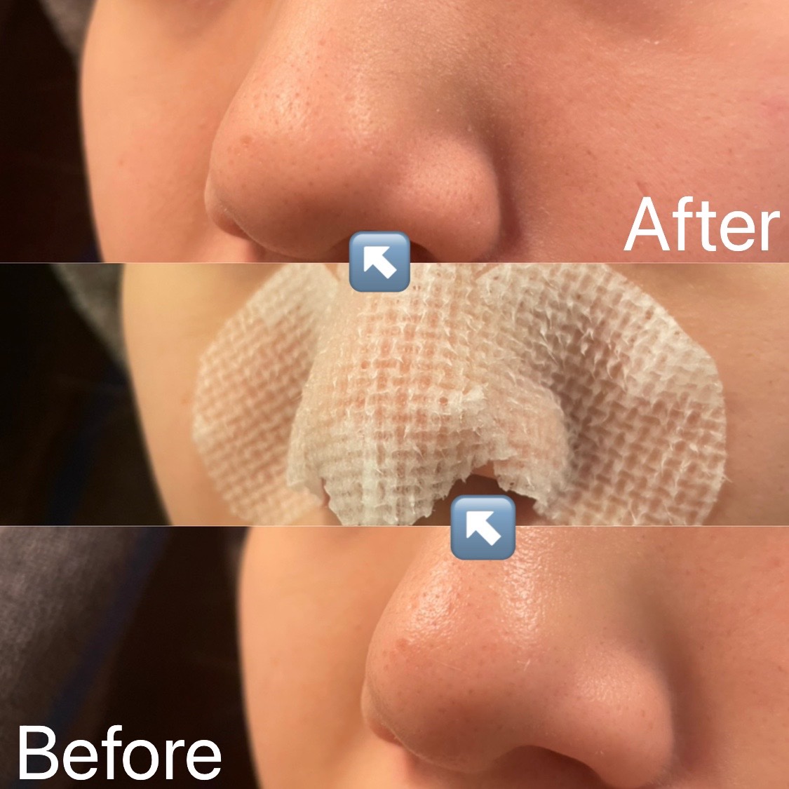 ノーズピーリングパック/One-day's you/シートマスク・パックを使ったクチコミ（2枚目）