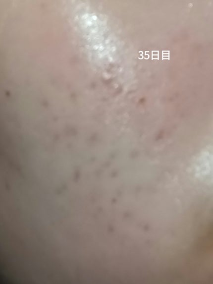 いぬ✢フォロバ100✢ on LIPS 「自分用記録デュアック35日目サボリすぎたかも、赤みが引かない、..」(1枚目)
