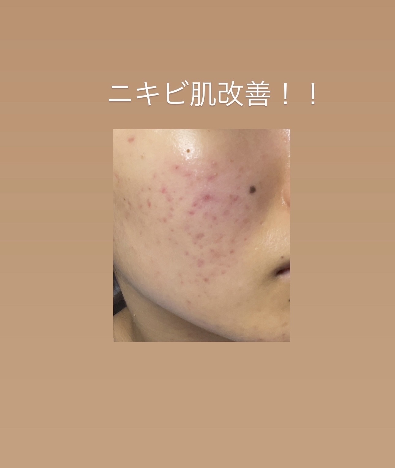 ビオレ ザフェイス 泡洗顔料 アクネケア/ビオレ/泡洗顔を使ったクチコミ（1枚目）