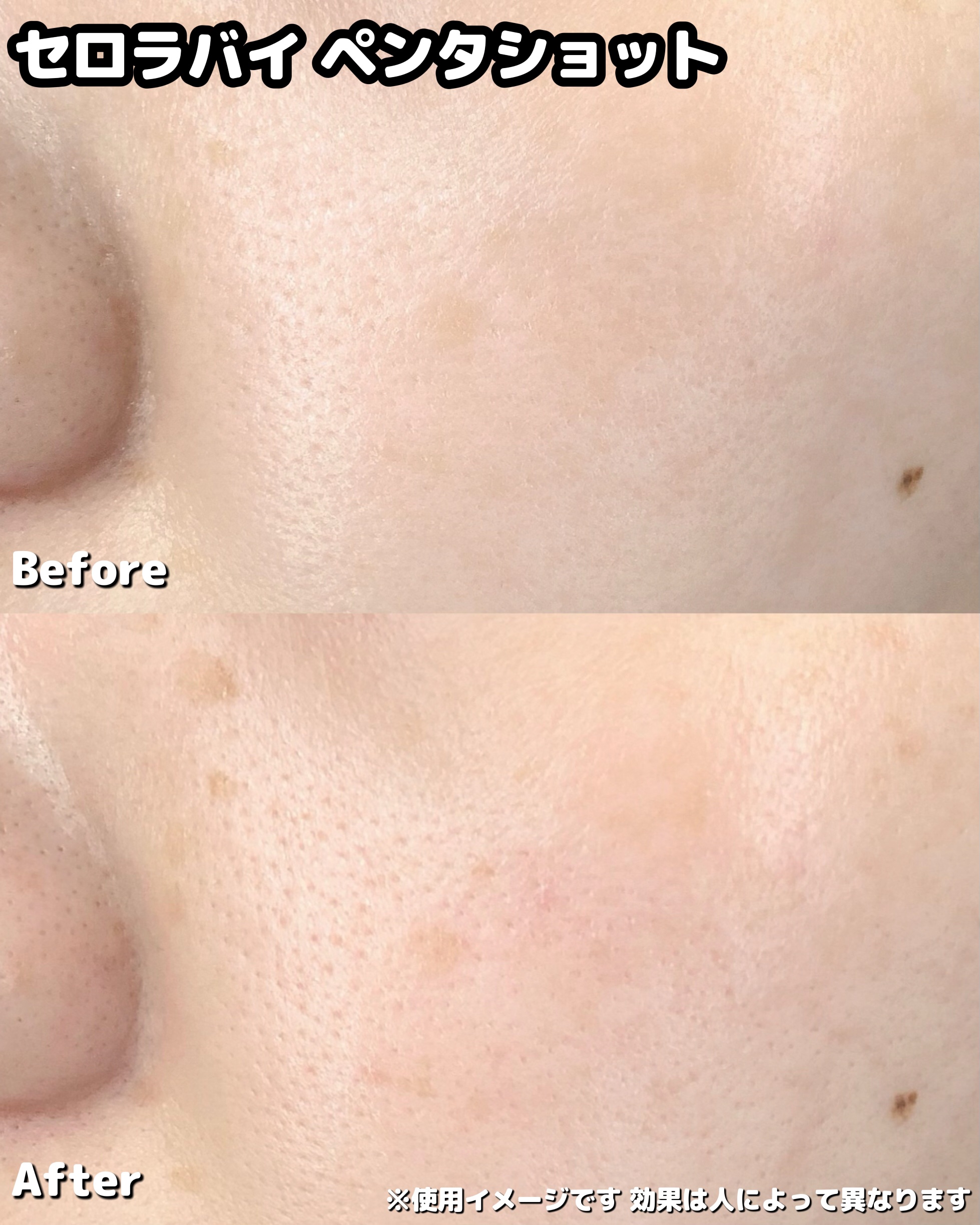 ペンタショット/CELORABY/美顔器・マッサージを使ったクチコミ（3枚目）