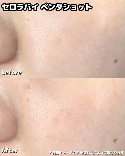 ペンタショット/CELORABY/美顔器・マッサージを使ったクチコミ(3枚目)