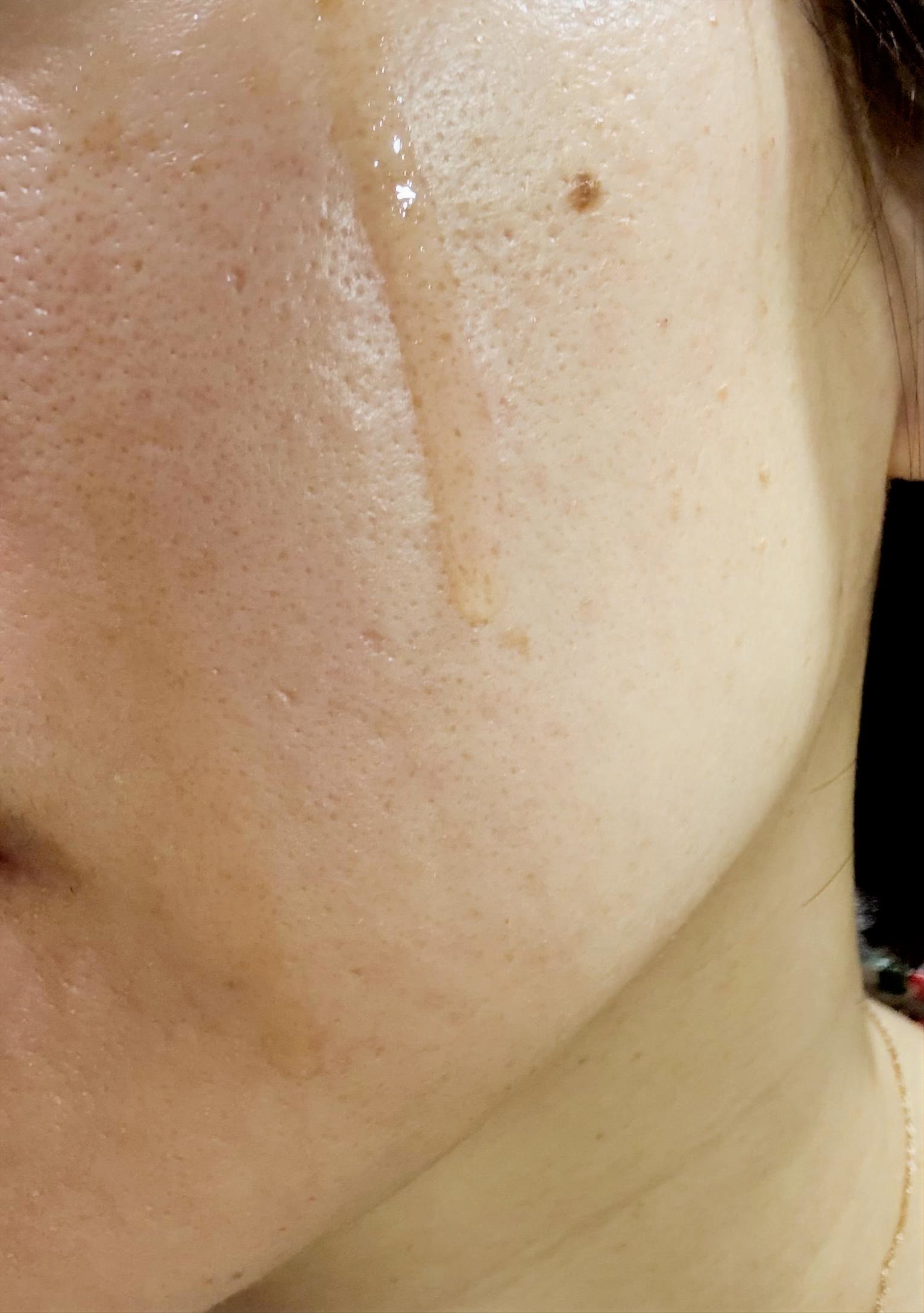 RXザ・アルファアルブチン2 ニキビ跡ケアセラム/COSRX/美容液を使ったクチコミ（2枚目）