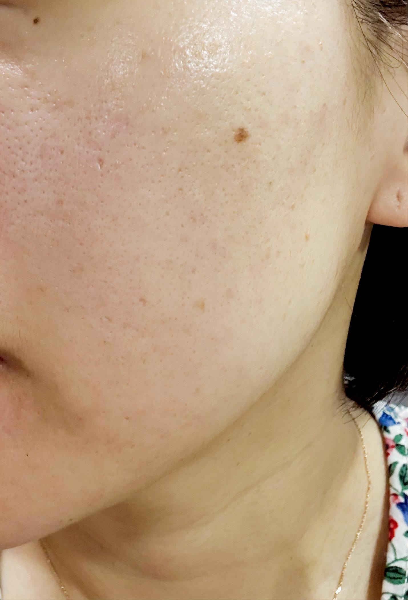 RXザ・アルファアルブチン2 ニキビ跡ケアセラム/COSRX/美容液を使ったクチコミ（3枚目）