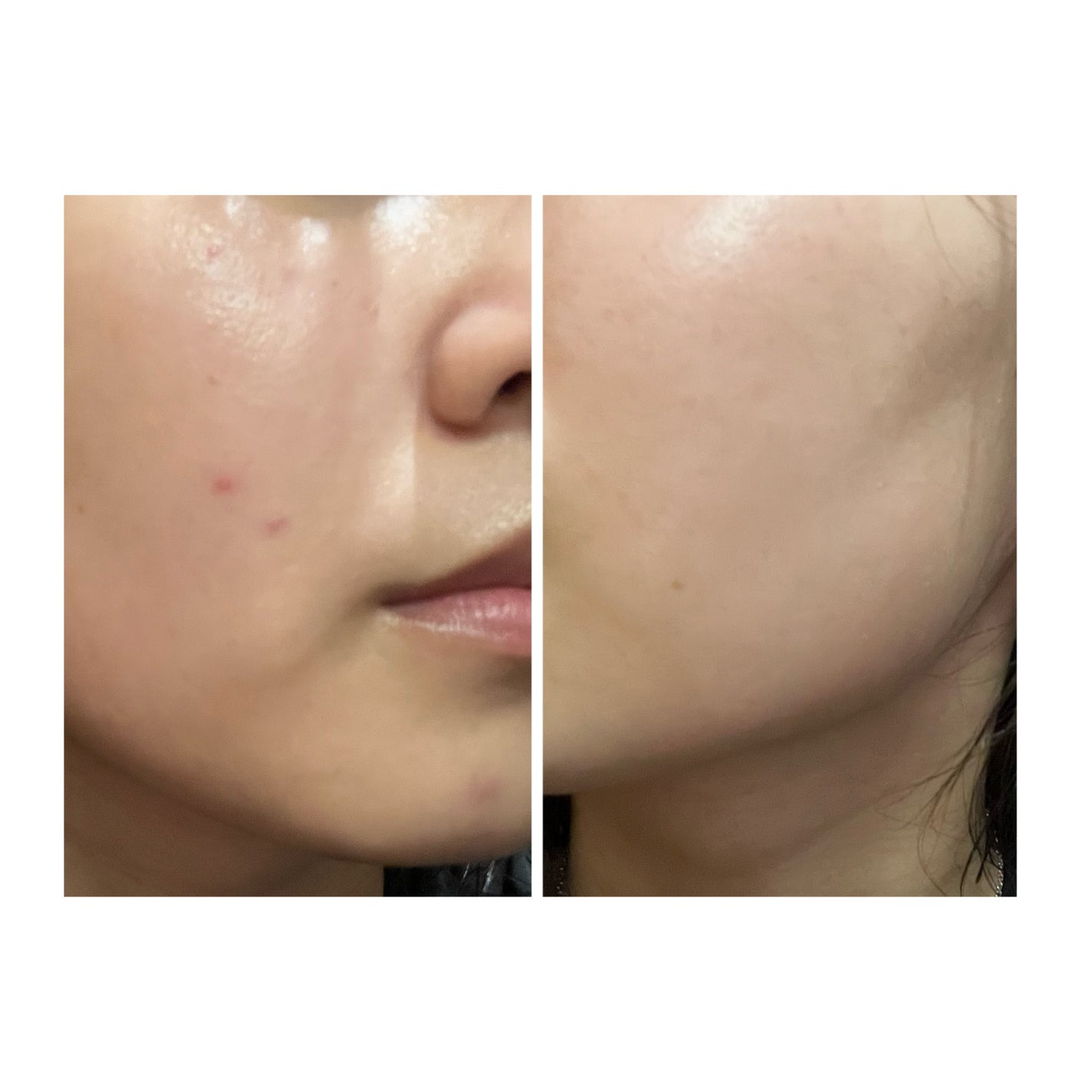 ぽむ on LIPS 「2023.9.13皮膚科に受診 エピデュオとヘパリン処方1枚目..」(4枚目)