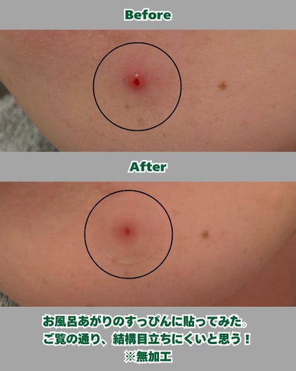 ゼロスポットパッチCICA/Today’s Cosme/その他スキンケアを使ったクチコミ(4枚目)