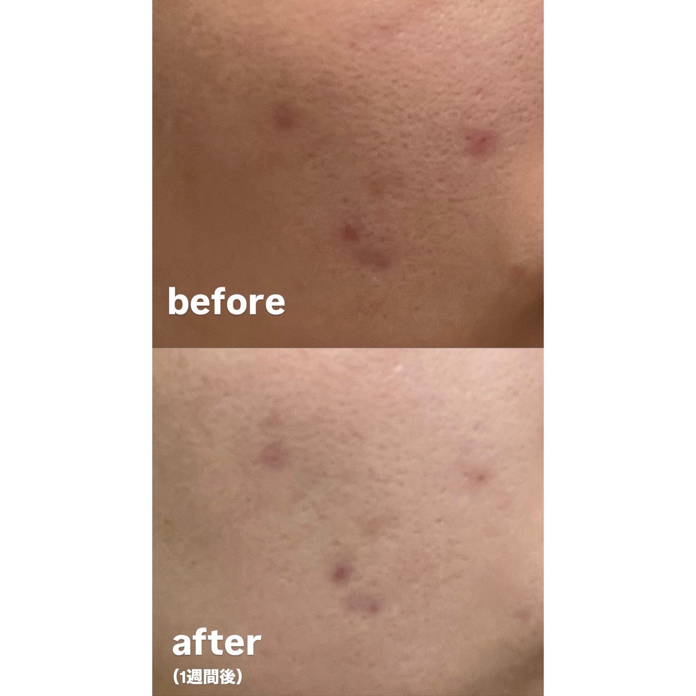 RXザ・アルファアルブチン2 ニキビ跡ケアセラム/COSRX/美容液を使ったクチコミ(8枚目)