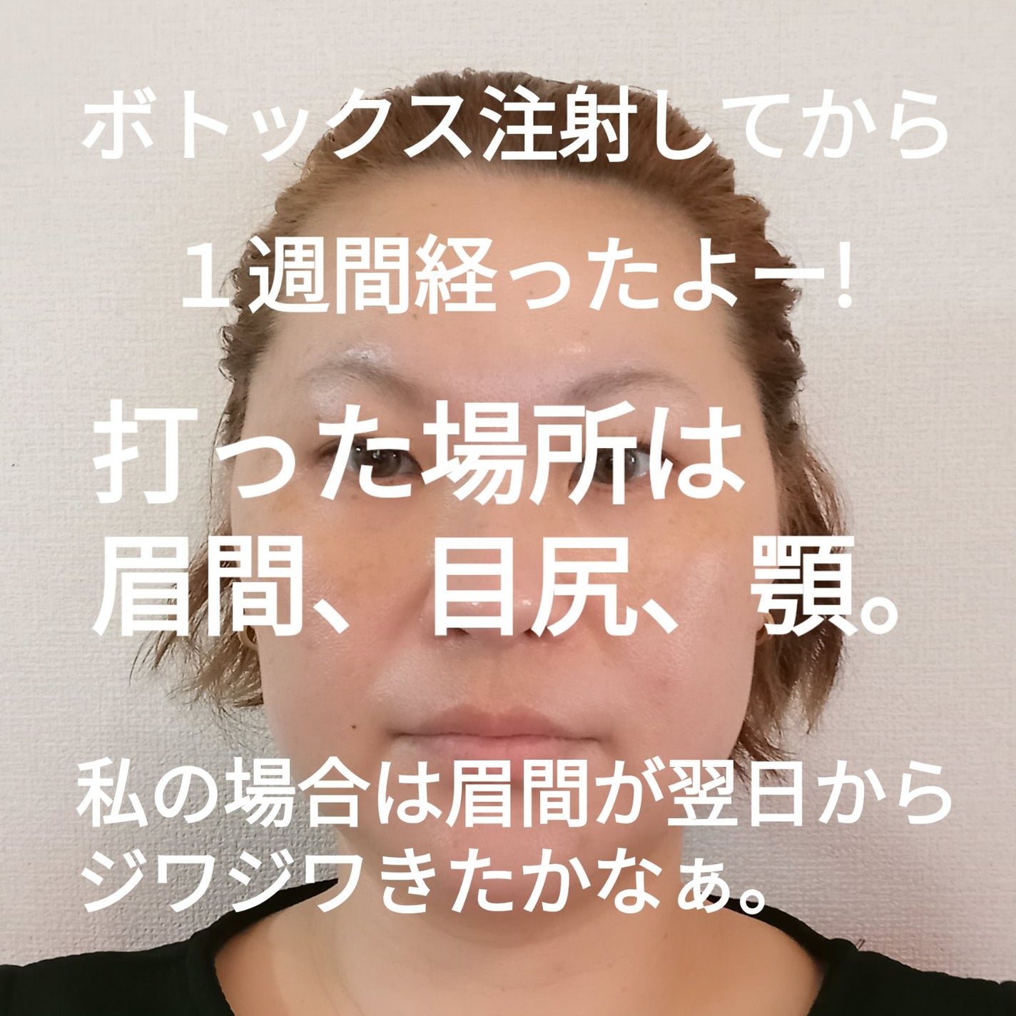 ビヨンセ奥二重向上委員長🥸LIPSパートナー🥳 on LIPS 「SBC韓国製ボツリヌストキシン結果から言いますとーやって良かっ..」(1枚目)