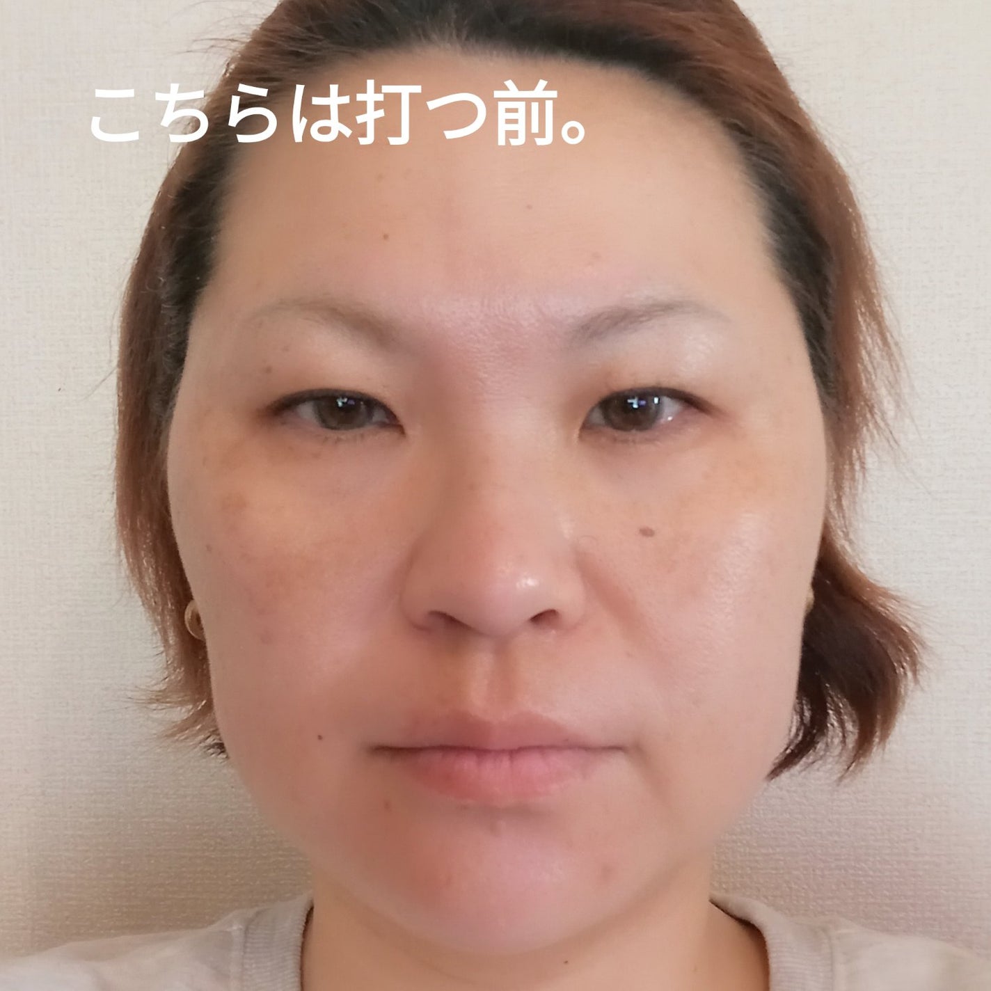 ビヨンセ奥二重向上委員長🥸LIPSパートナー🥳 on LIPS 「SBC韓国製ボツリヌストキシン結果から言いますとーやって良かっ..」(2枚目)