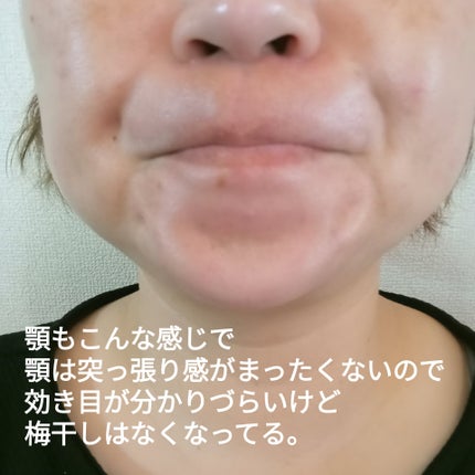 ビヨンセ奥二重向上委員長🥸LIPSパートナー🥳 on LIPS 「SBC韓国製ボツリヌストキシン結果から言いますとーやって良かっ..」(7枚目)