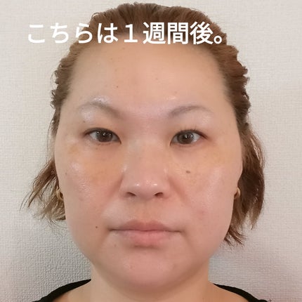 ビヨンセ奥二重向上委員長🥸LIPSパートナー🥳 on LIPS 「SBC韓国製ボツリヌストキシン結果から言いますとーやって良かっ..」(4枚目)