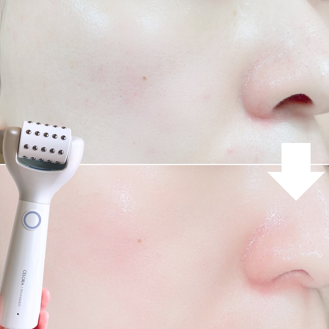 ペンタショット/CELORABY/美顔器・マッサージを使ったクチコミ（2枚目）