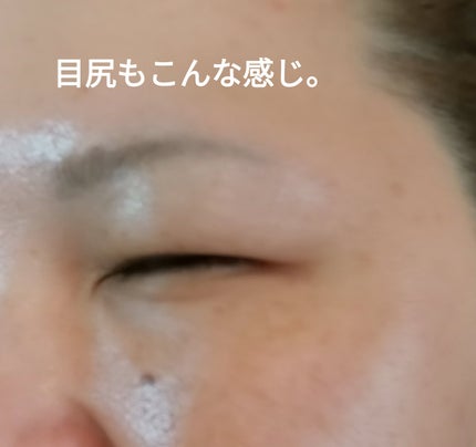 ビヨンセ奥二重向上委員長🥸LIPSパートナー🥳 on LIPS 「SBC韓国製ボツリヌストキシン結果から言いますとーやって良かっ..」(6枚目)