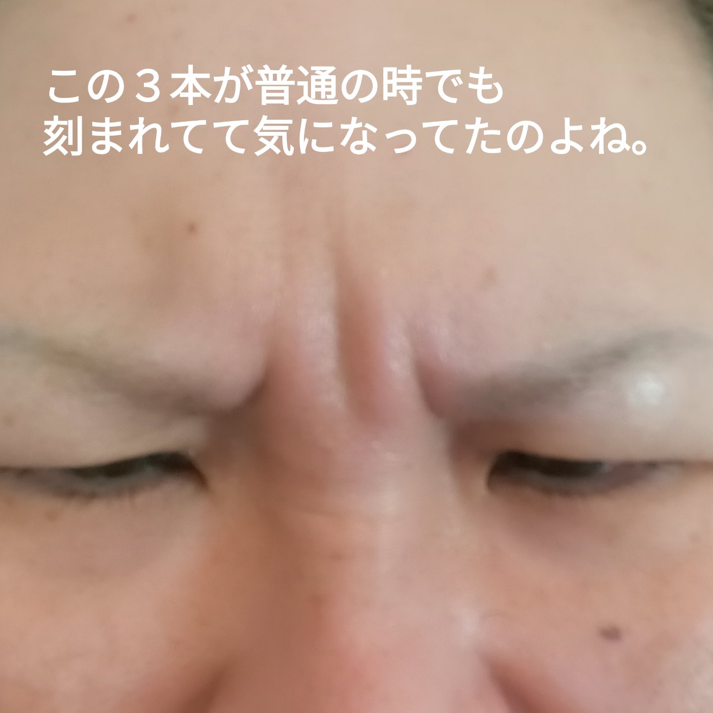 韓国製ボツリヌストキシン/SBC/その他を使ったクチコミ（3枚目）