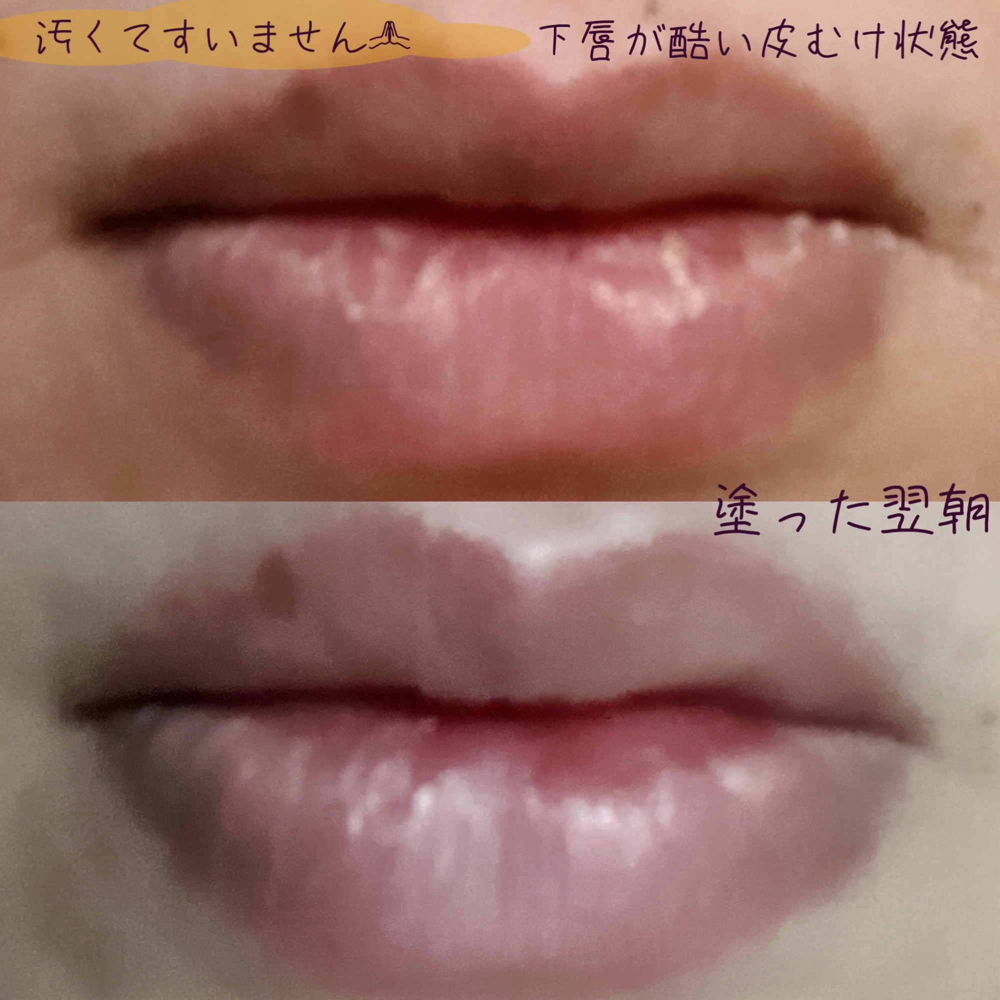 メディカルリップn(医薬品)/メンソレータム/その他を使ったクチコミ（3枚目）