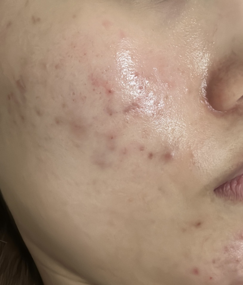 コラージュフルフル 泡石鹸/コラージュ/デリケートゾーンケアを使ったクチコミ（3枚目）