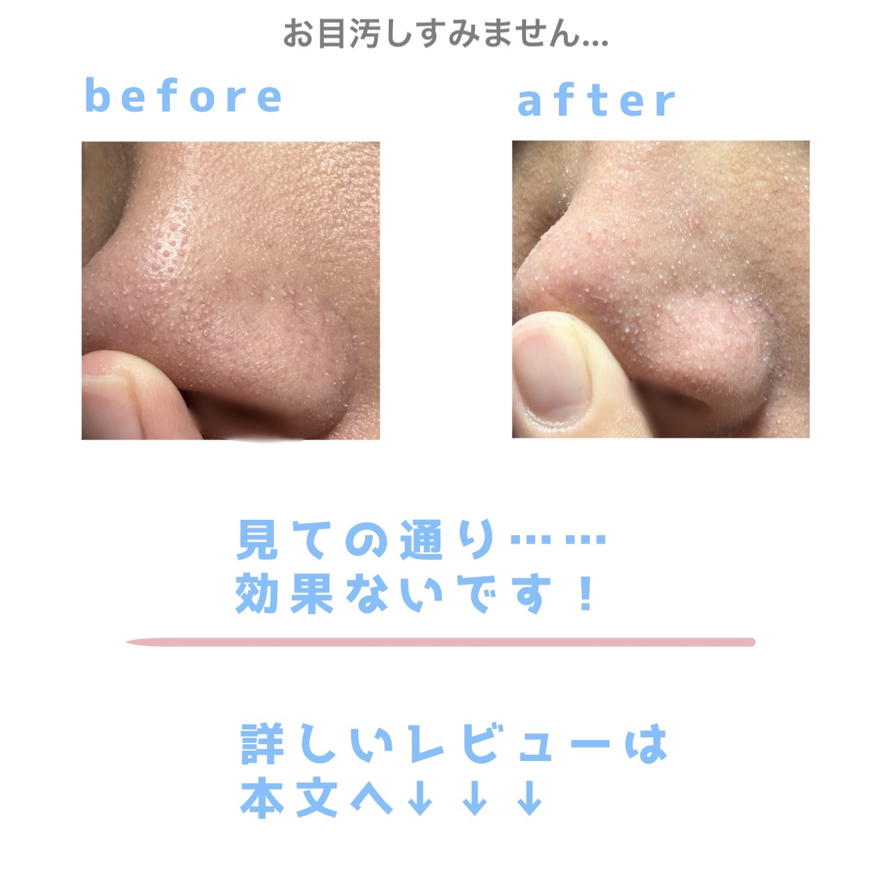 リポピールセラム/LIPOPEEL/美容液を使ったクチコミ（2枚目）