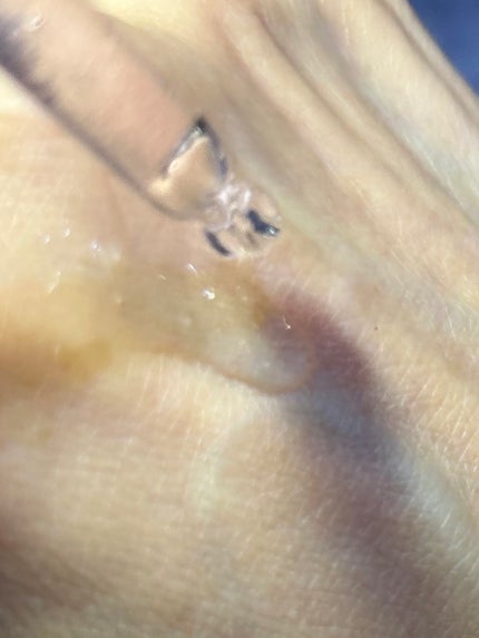 シークレットソリューションPDRNカプセルアンプル/It's skin/美容液を使ったクチコミ(5枚目)