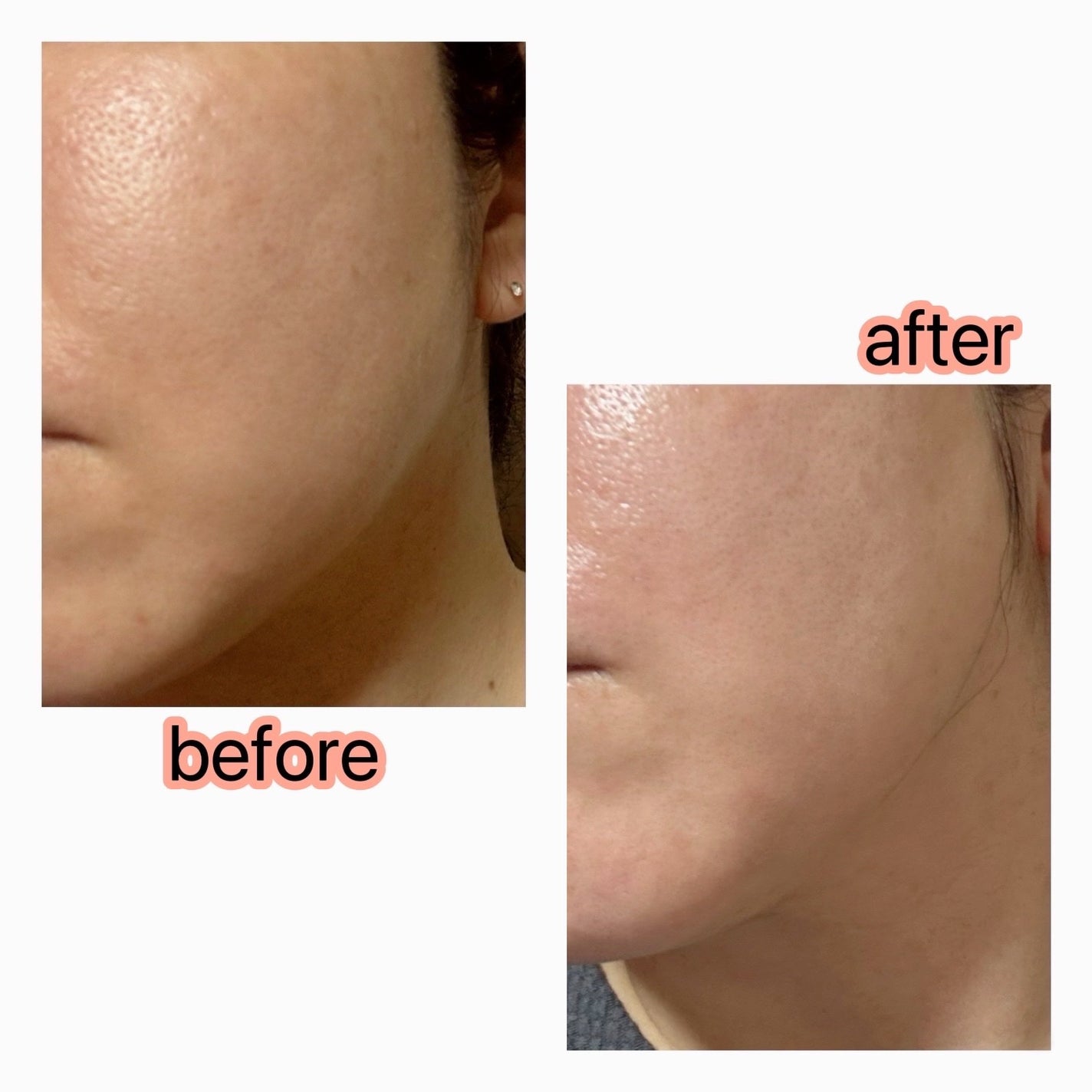 リードルS PDRN+ セラム/VT/美容液を使ったクチコミ(5枚目)