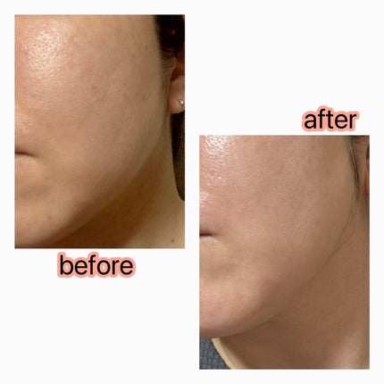 リードルS PDRN+ セラム/VT/美容液を使ったクチコミ(5枚目)