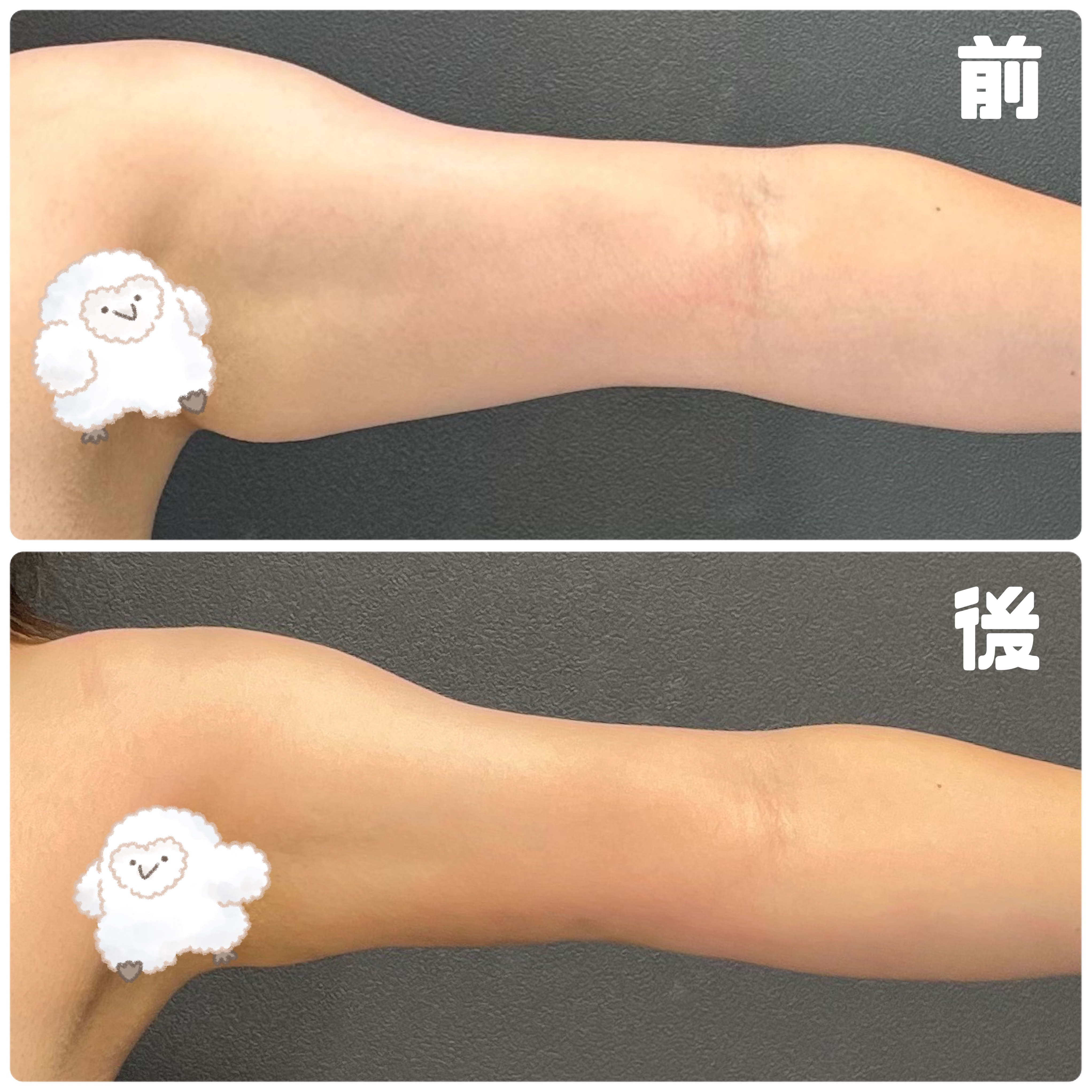 全身ローラー(ボディー用)/DAISO/ボディローラーを使ったクチコミ（2枚目）