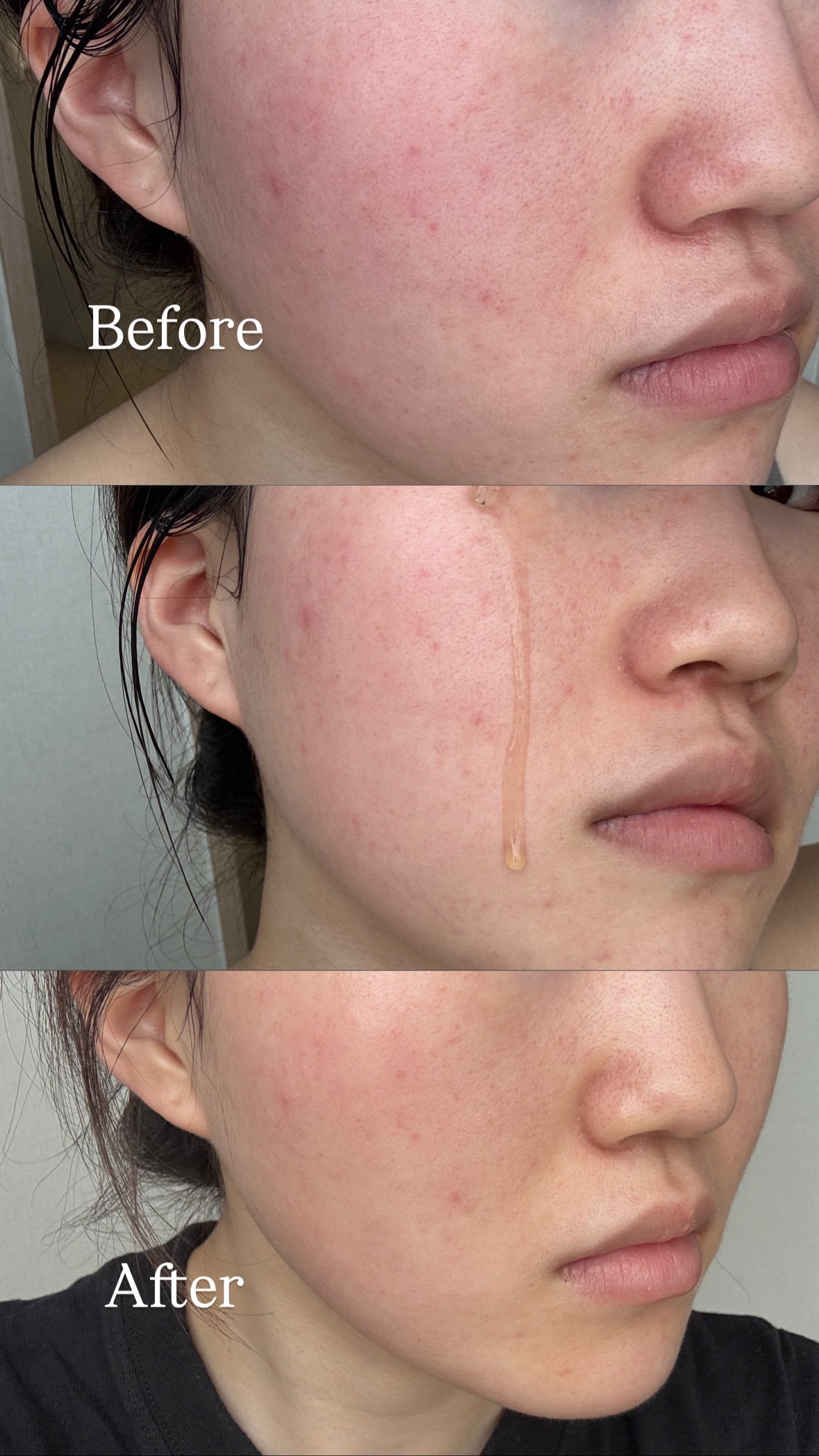 RXザ・アルファアルブチン2 ニキビ跡ケアセラム/COSRX/美容液を使ったクチコミ（3枚目）