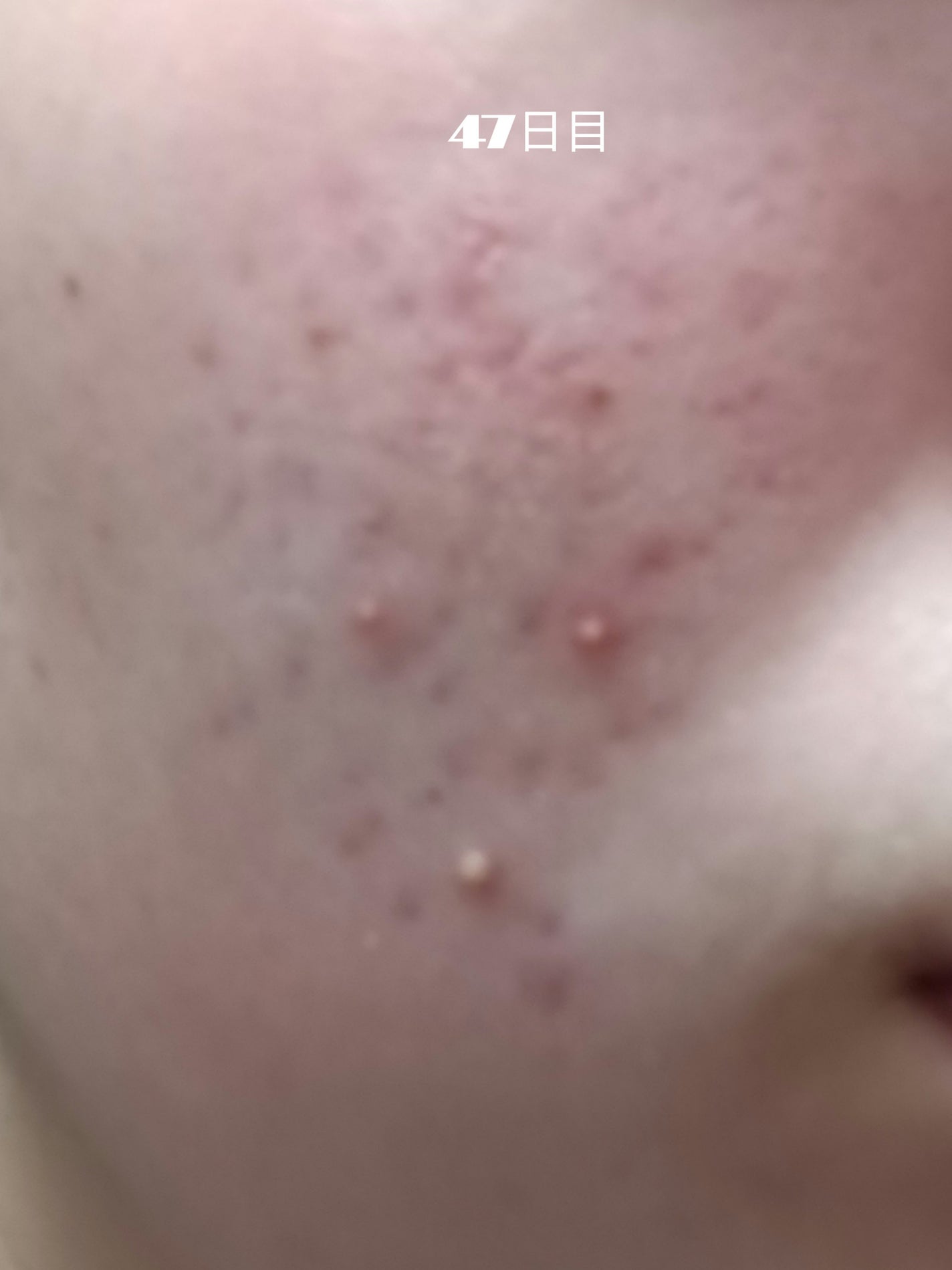 いぬ✢フォロバ100✢ on LIPS 「自分用記録デュアック47日目ニキビ3つできた!夏の大三角です!..」(1枚目)