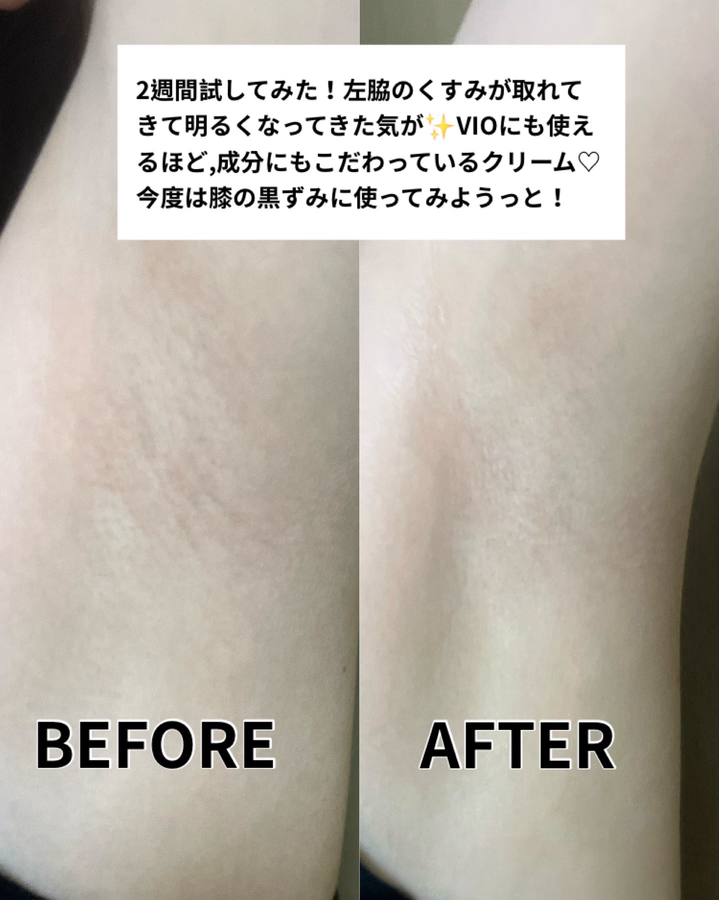 BnDアンダーアームクリーム(ボディクリーム)/BnD/デリケートゾーンケアを使ったクチコミ（3枚目）