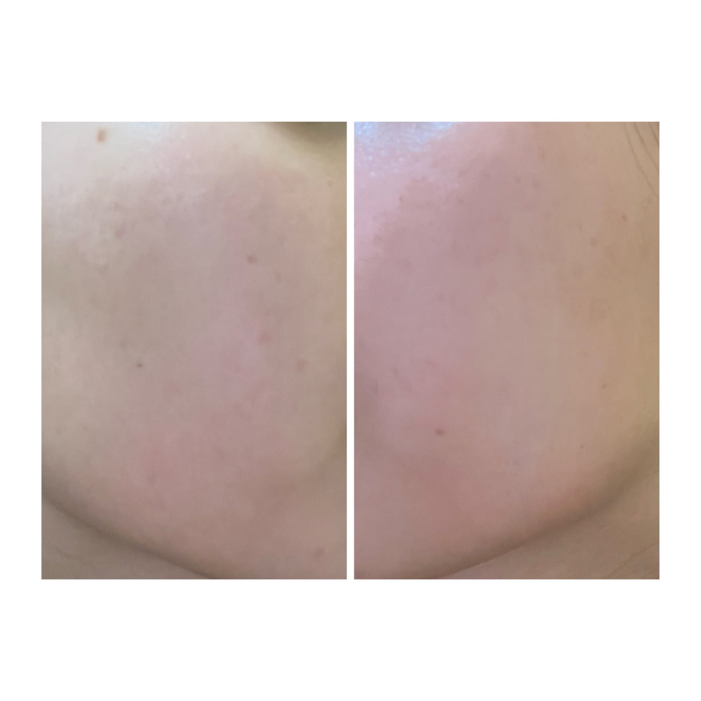 ぽむ on LIPS 「2023.9.13皮膚科に受診 エピデュオとヘパリン処方1枚目..」(1枚目)