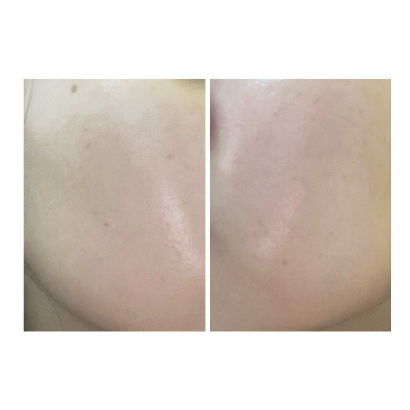 ぽむ on LIPS 「2023.9.13皮膚科に受診 エピデュオとヘパリン処方1枚目..」(4枚目)