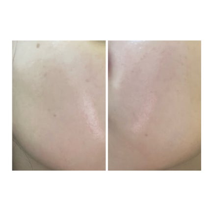 ぽむ on LIPS 「2023.9.13皮膚科に受診 エピデュオとヘパリン処方1枚目..」(4枚目)