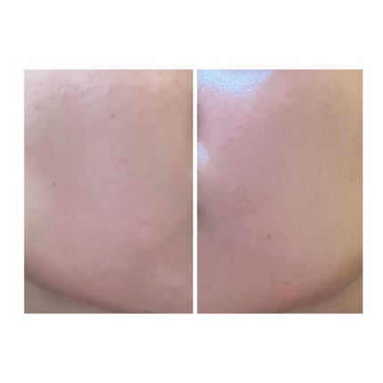 ぽむ on LIPS 「2023.9.13皮膚科に受診 エピデュオとヘパリン処方1枚目..」(5枚目)