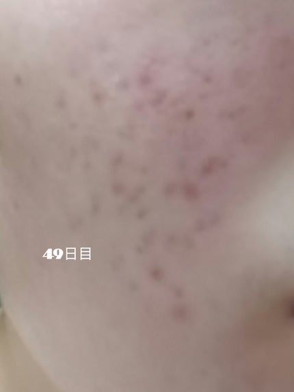 いぬ✢フォロバ100✢ on LIPS 「自分用記録デュアック49日目やはりニキビいつのまにか潰してしま..」(1枚目)