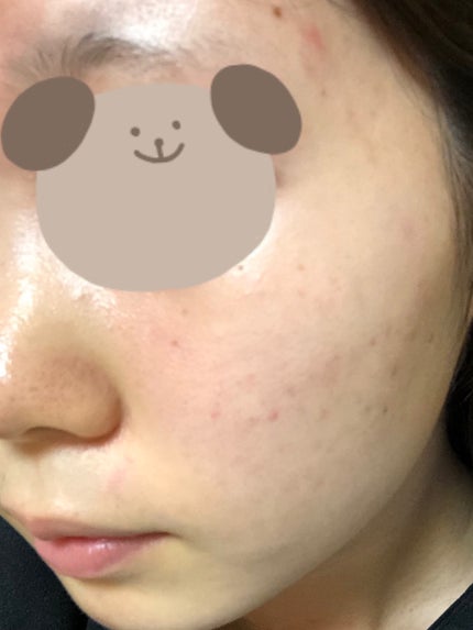 ひな@LIPSパートナー on LIPS 「今回はお金のない私のニキビ肌改善方法についてのご紹介🤭💐・ニキ..」(8枚目)