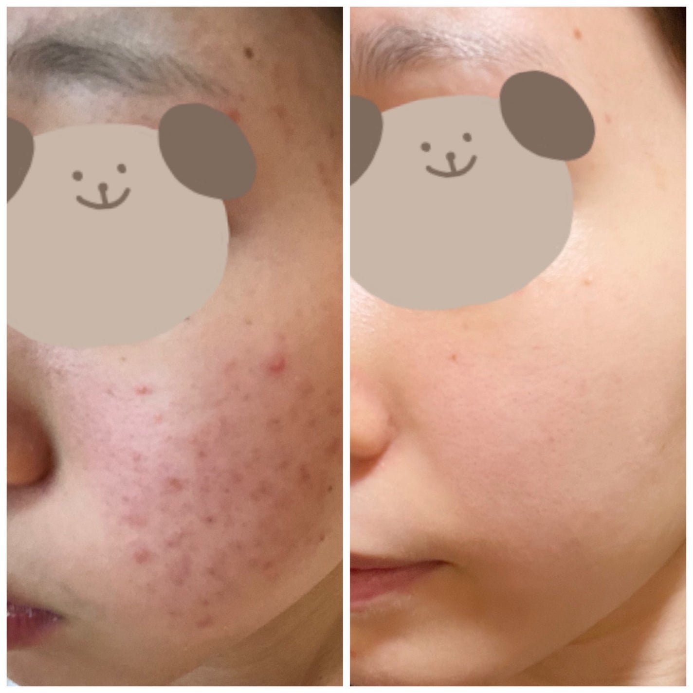 ひな@LIPSパートナー on LIPS 「今回はお金のない私のニキビ肌改善方法についてのご紹介🤭💐・ニキ..」(1枚目)