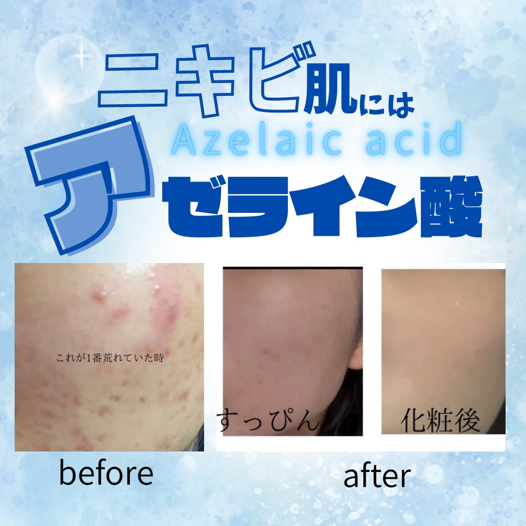 ダーマレーザー ウルセラAZ/クオリティファースト/美容液を使ったクチコミ（1枚目）