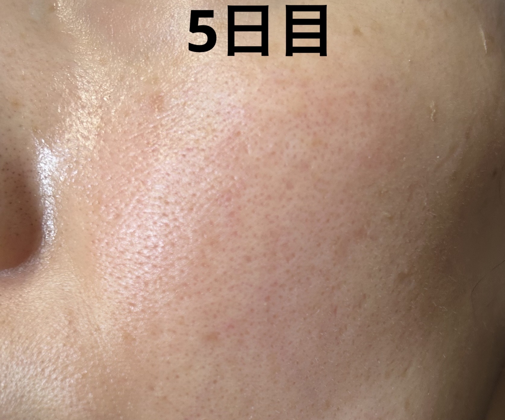 ボタニカルピール ピーリングパウダー Lv7/BOTANICAL PEEL/ピーリングを使ったクチコミ（3枚目）