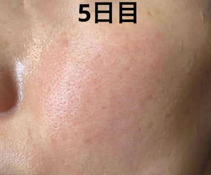 BOTANICAL PEEL ボタニカルピール ピーリングパウダー Lv7のクチコミ「ボタニカルピール ピーリングパウダー Lv7
🌸1回目使用してみての感想🌸
1ヶ月に1度の.....」(3枚目)