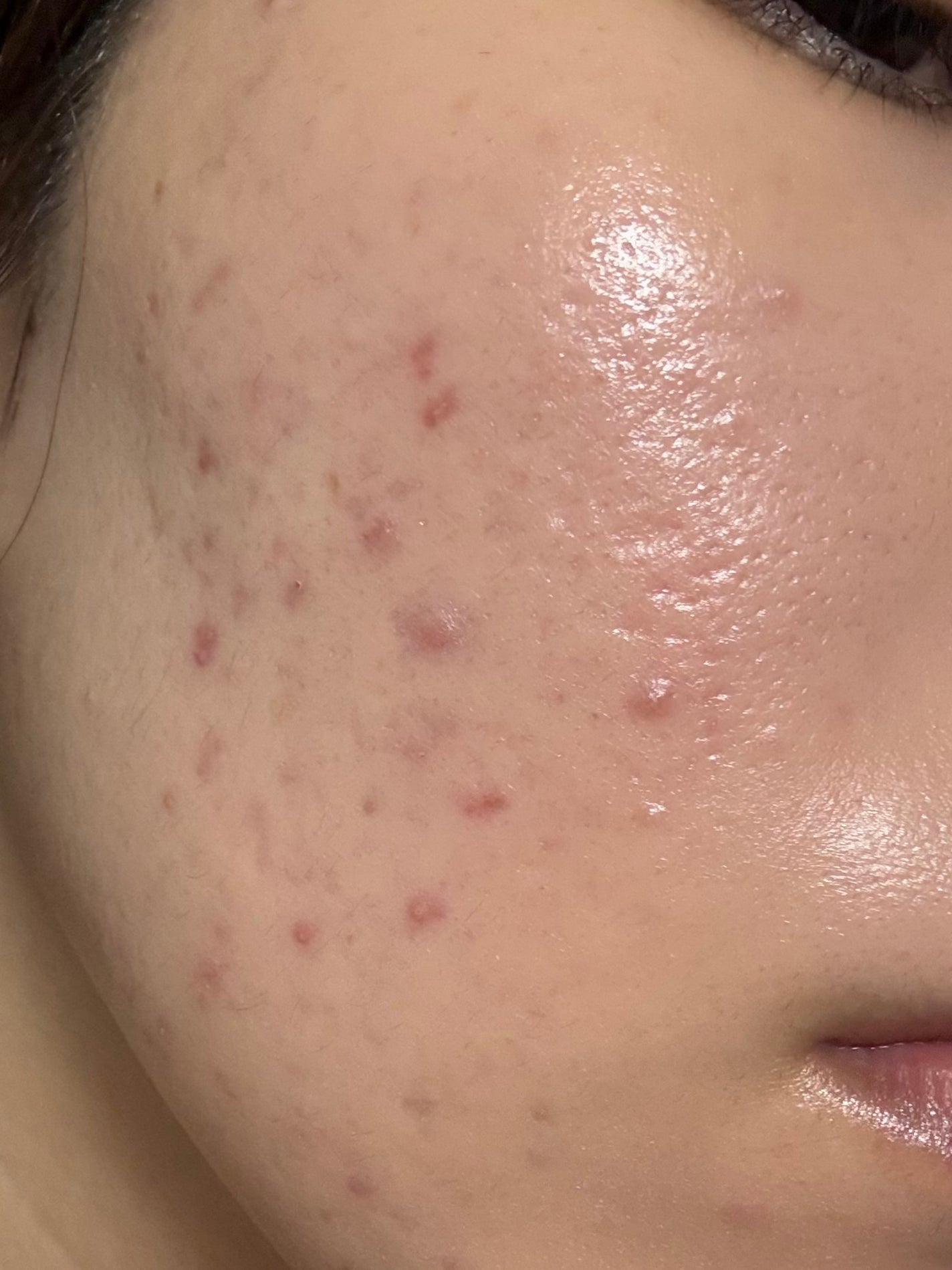 twinkle_blush_pbr on LIPS 「2025/08/15肌荒れ落ち着いたと思っても生理後荒れちゃう..」(2枚目)