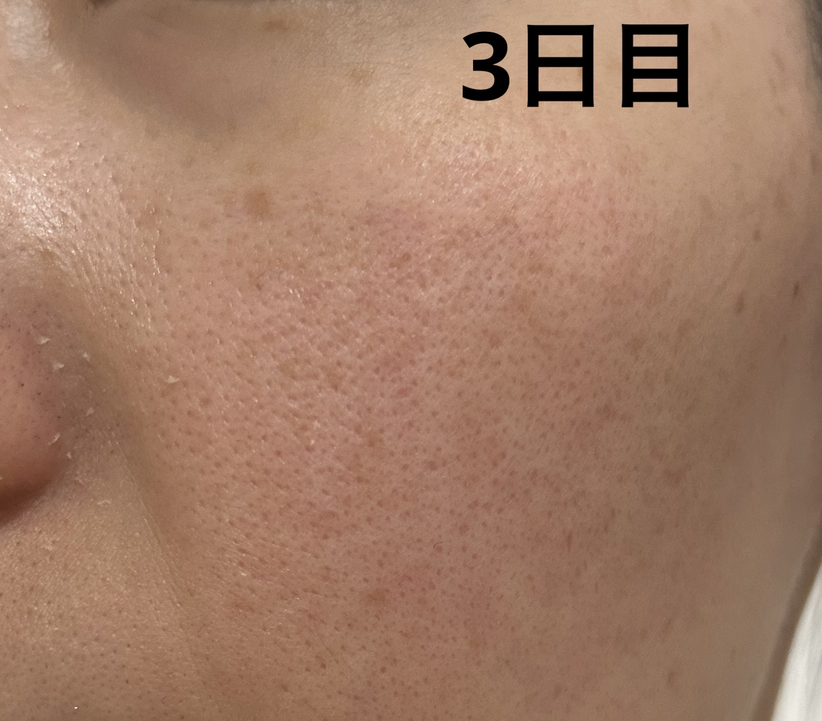 ボタニカルピール ピーリングパウダー Lv7/BOTANICAL PEEL/ピーリングを使ったクチコミ（1枚目）